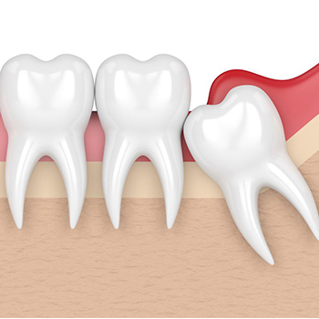 Tooth Alignment in Vijayawada